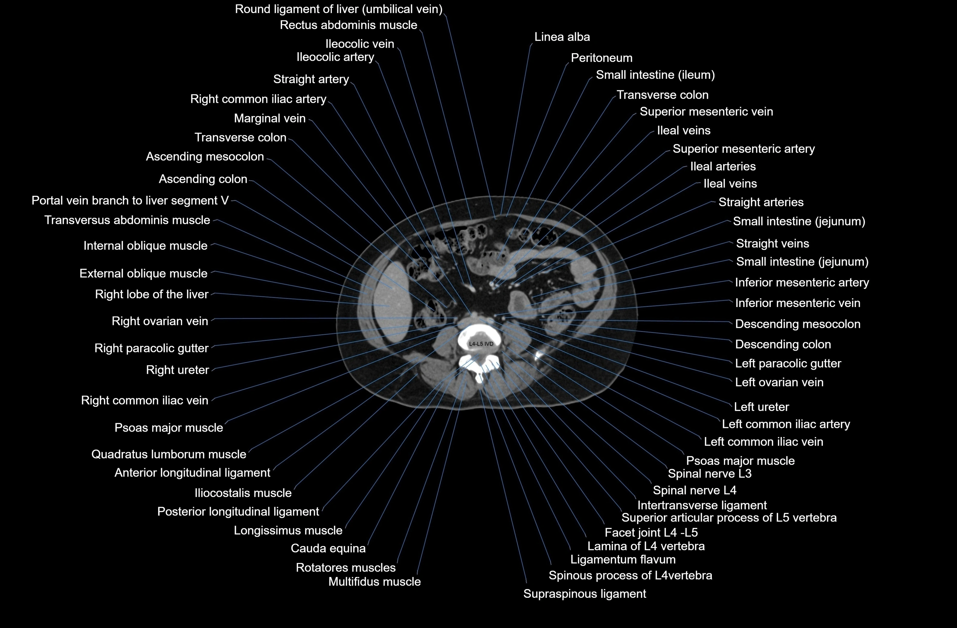 CT Abdomen axial cross sectional anatomy labelled radiology image-00054.webp